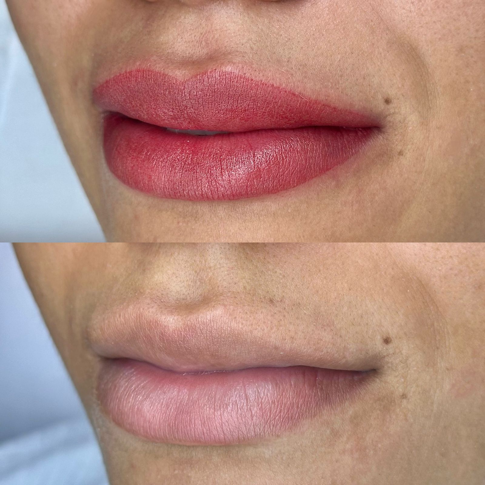 Revitalização labial — foto 1