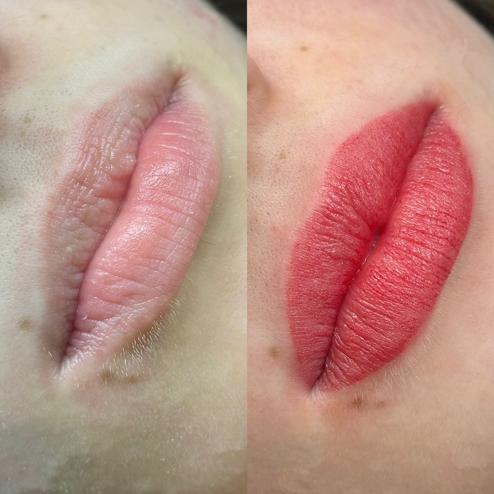 Revitalização labial — foto 4